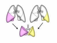 肺移植 wiki